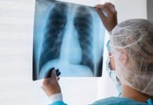tuberculose